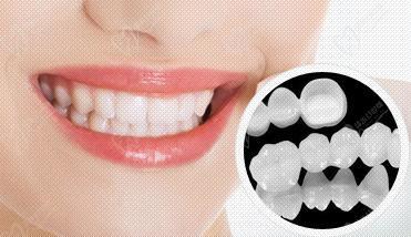 常德美奧口腔牙齒美白修復優惠活動