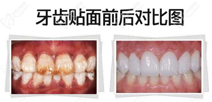 我做牙齒貼面5年后感受規模，看瓷貼面效果圖