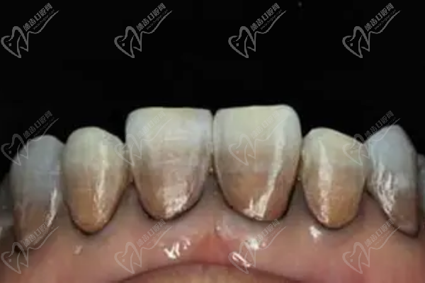 四環素牙屬于外源性著色牙嗎