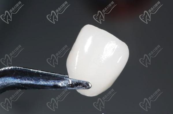 牙齒貼面多久可以做好的發生？